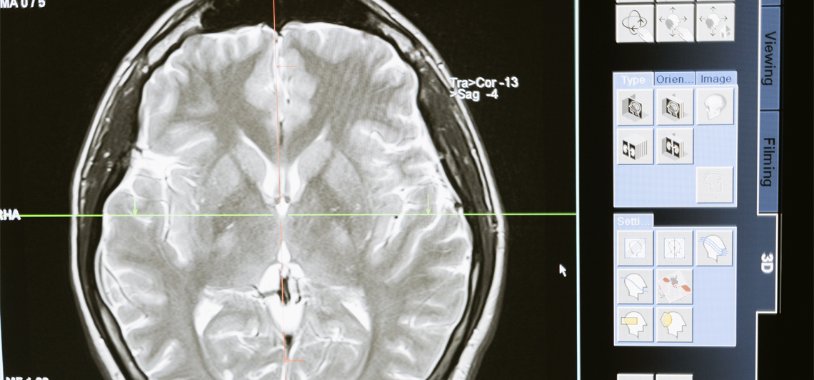 Depresión y redes cerebrales: ¿Qué sabemos en la actualidad sobre la depresión y nuestro cerebro?