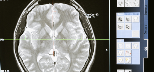 Depresión y redes cerebrales: ¿Qué sabemos en la actualidad sobre la depresión y nuestro cerebro?